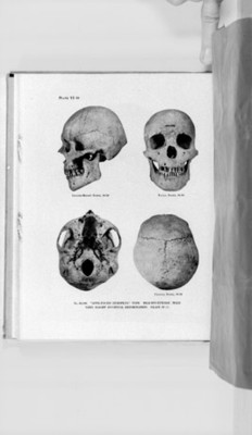 Cráneo antropomorfo con deformación en la zona frontal y parietal, ilustración