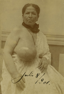 Mujer con mastitis